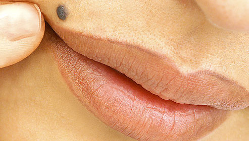 How to tell if a mole is cancerous